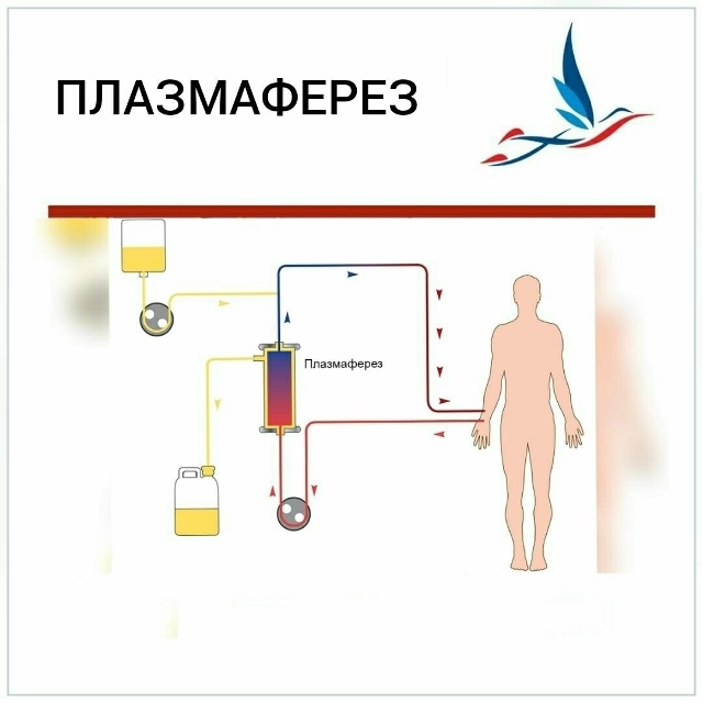 Плазмаферез в ОККД Плазмаферез в ОККД