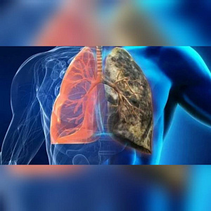 Неделя профилактики рака лёгких 